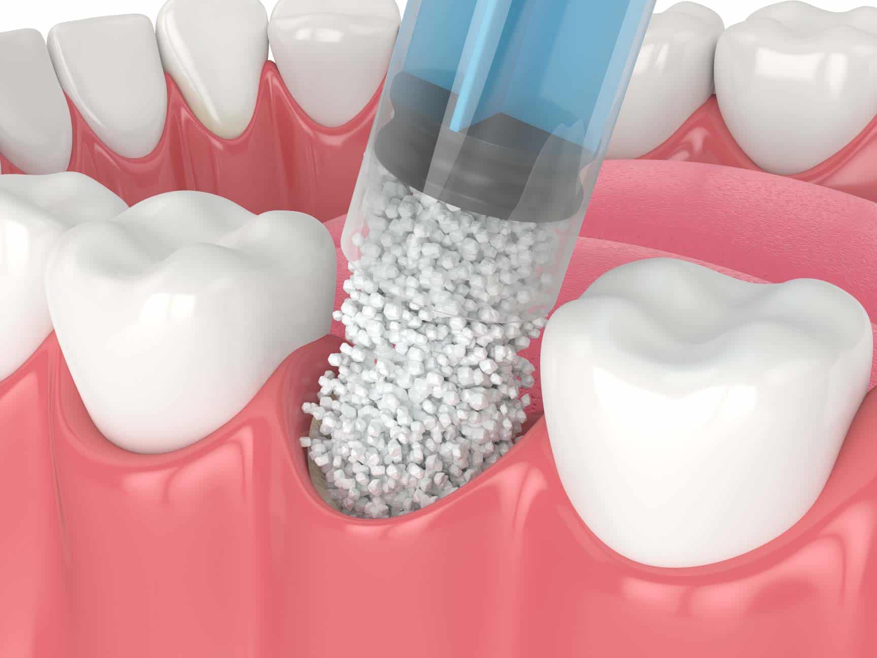 Dental bone graft procedure illustration