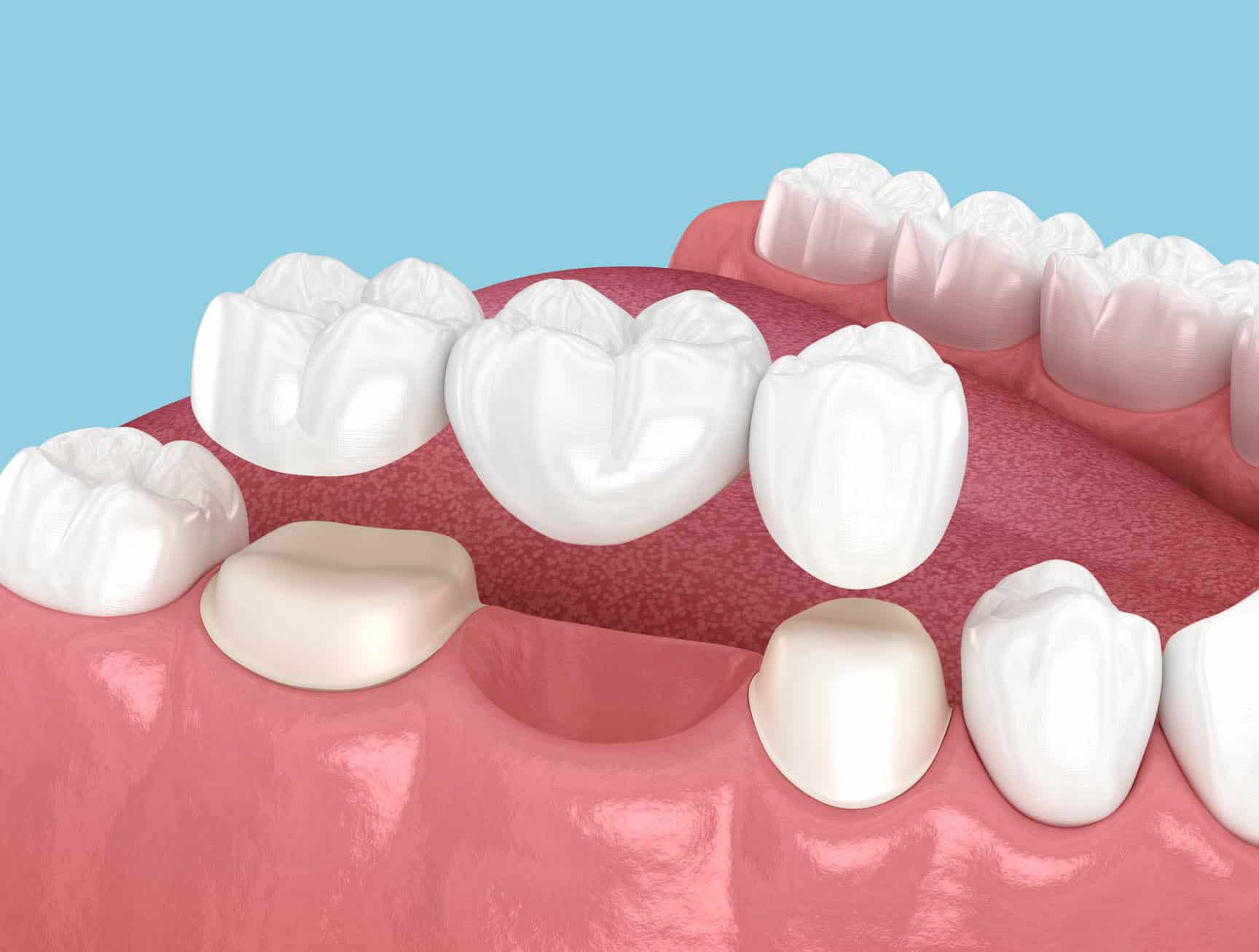 Dental bridge illustration