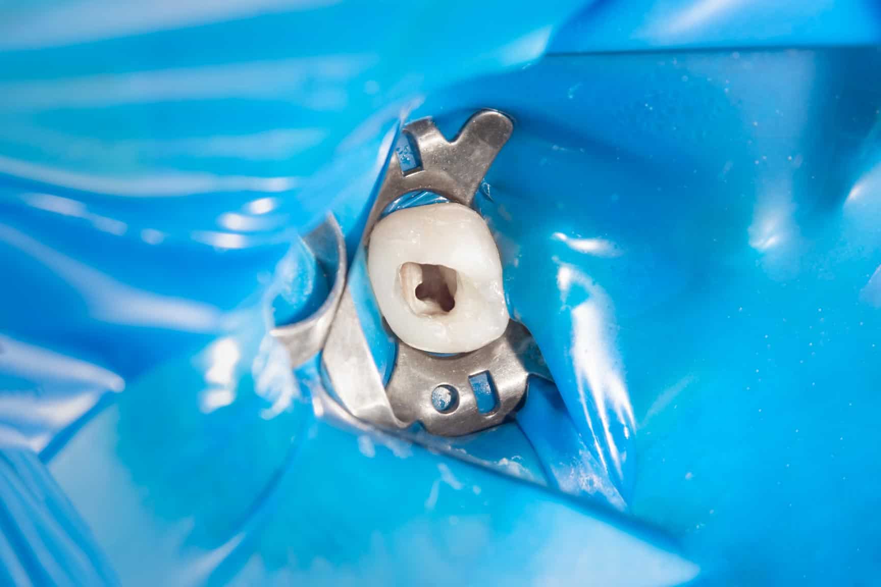 Root canal treatment